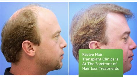 best mens hair restoration st louis|About Moore Hair Clinic – St. Louis, Mo. .
